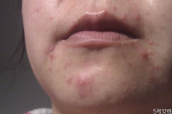 下巴的粉刺應該怎么去除 去除下巴粉刺的方法 下巴的粉刺應該怎么去除 去除下巴粉刺的方法