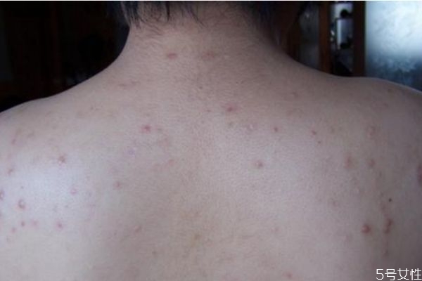 背上的痘痘應(yīng)該怎么去除 背上的痘痘應(yīng)該怎么去除