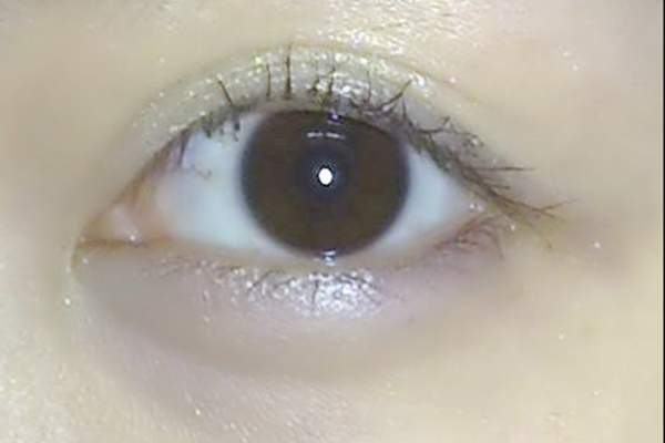 黑眼圈有哪幾種類型 黑眼圈有哪幾種類型