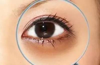 黑眼圈有哪幾種類型 黑眼圈有哪幾種類型