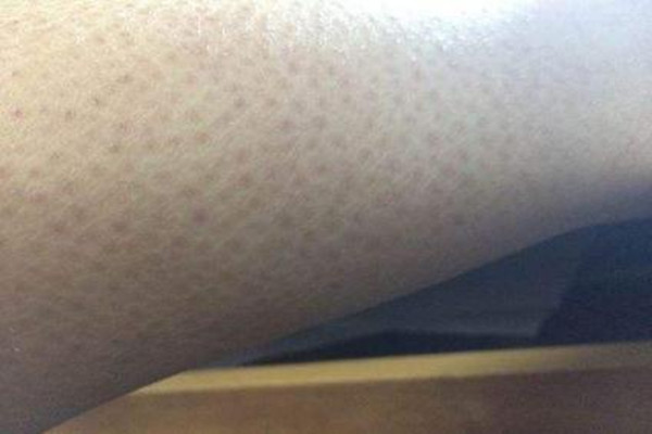 毛角周化好發(fā)于什么年齡 毛角周化什么年齡容易長 毛角周化好發(fā)于什么年齡 毛角周化什么年齡容易長