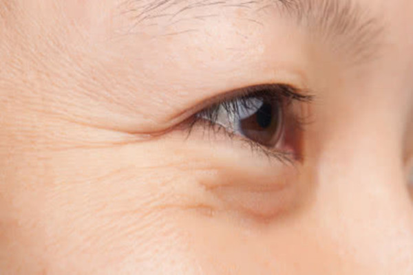 細(xì)紋和干紋的區(qū)別 細(xì)紋和皺紋的區(qū)別