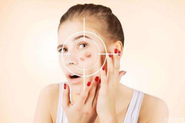 為什么不可以用手擠痘痘 不能用手擠痘痘的原因 為什么不可以用手擠痘痘 不能用手擠痘痘的原因