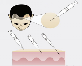 自體毛發(fā)種植多少錢(qián) 自體毛發(fā)種植哪一步最關(guān)鍵