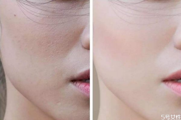 皮膚出油毛孔大怎么解決 皮膚缺水冒油怎么辦 皮膚出油毛孔大怎么解決 皮膚缺水冒油怎么辦