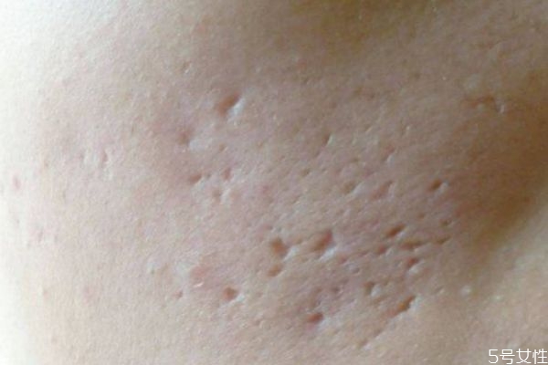 臉上有痘坑怎么辦 臉上痘坑怎么消除 臉上有痘坑怎么辦 臉上痘坑怎么消除