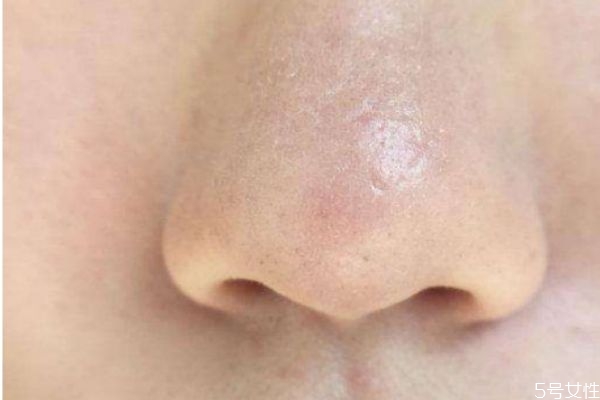 如何預(yù)防鼻子卡粉 如何解決鼻子卡粉 如何預(yù)防鼻子卡粉 如何解決鼻子卡粉