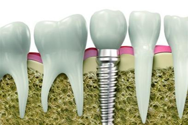 種植牙齒二期幾天能拆線 種植牙齒多久能好 種植牙齒二期幾天能拆線 種植牙齒多久能好