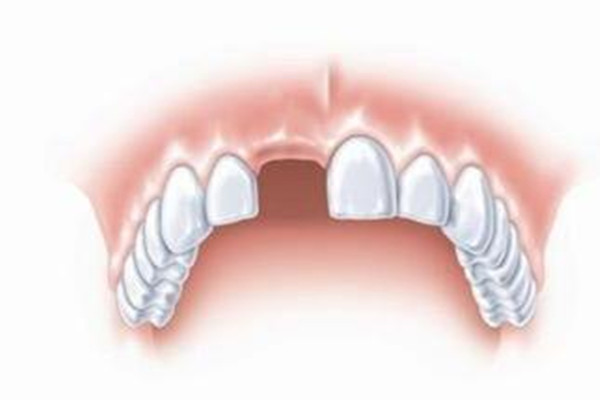 什么情況下適合種植牙齒 種植牙齒分為幾個階段 什么情況下適合種植牙齒 種植牙齒分為幾個階段