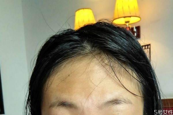 額頭皮膚粗糙怎么辦 額頭皮膚粗糙怎么解決 額頭皮膚粗糙怎么辦 額頭皮膚粗糙怎么解決
