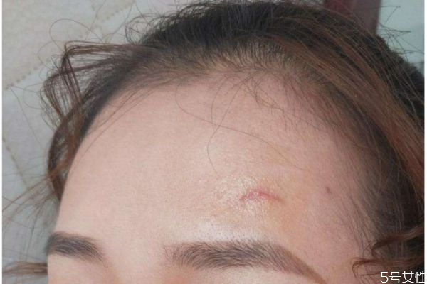 額頭皮膚粗糙怎么辦 額頭皮膚粗糙怎么解決 額頭皮膚粗糙怎么辦 額頭皮膚粗糙怎么解決