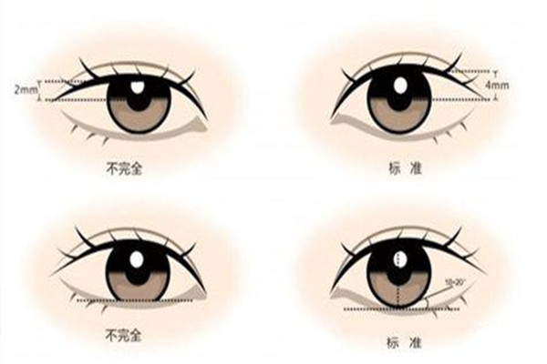 什么是雙眼皮修復(fù) 什么情況下需要雙眼皮修復(fù) 什么是雙眼皮修復(fù) 什么情況下需要雙眼皮修復(fù)