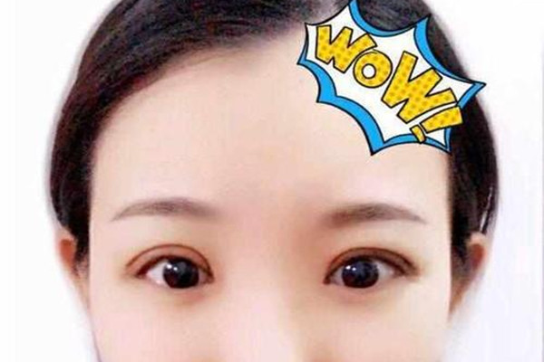 為什么壓雙眼皮看起來有緊繃感 術(shù)后眼睛要做哪些運(yùn)動(dòng) 為什么壓雙眼皮看起來有緊繃感 術(shù)后眼睛要做哪些運(yùn)動(dòng)