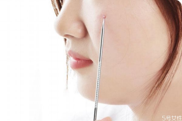 挑完粉刺后可不可以洗臉 粉刺挑完多久才能洗臉 挑完粉刺后可不可以洗臉 粉刺挑完多久才能洗臉