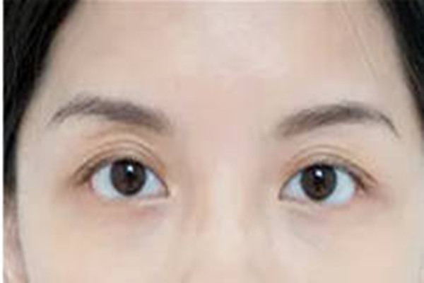 韓式去眼袋第二天會(huì)腫嗎 韓式去眼袋的注意事項(xiàng) 韓式去眼袋第二天會(huì)腫嗎 韓式去眼袋的注意事項(xiàng)