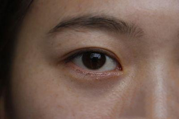 ?無痕去眼袋真的無痕嗎 無痕去眼袋術(shù)前注意事項(xiàng) ? ?無痕去眼袋真的無痕嗎 無痕去眼袋術(shù)前注意事項(xiàng) ?