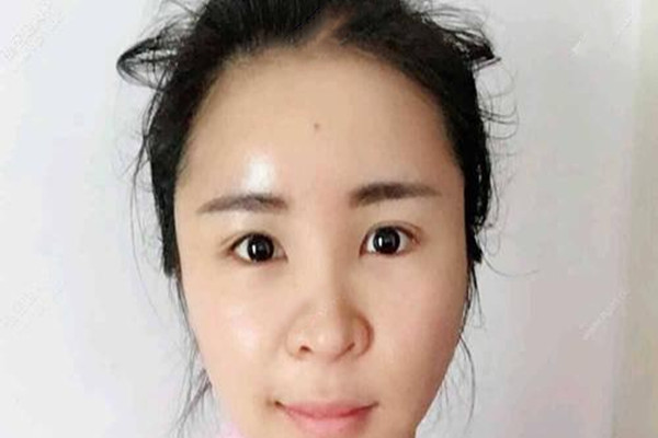 無(wú)痕去眼袋會(huì)不會(huì)反彈 無(wú)痕去眼袋比傳統(tǒng)去眼袋的優(yōu)勢(shì) 無(wú)痕去眼袋會(huì)不會(huì)反彈 無(wú)痕去眼袋比傳統(tǒng)去眼袋的優(yōu)勢(shì)