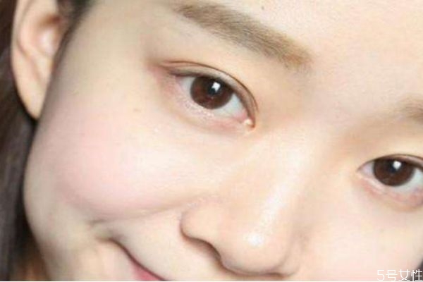 額頭長閉口是什么情況 為什么額頭反復(fù)長閉口 額頭長閉口是什么情況 為什么額頭反復(fù)長閉口