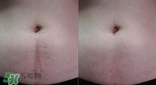 祛疤痕最好的方法有哪些？祛疤痕的簡單方法