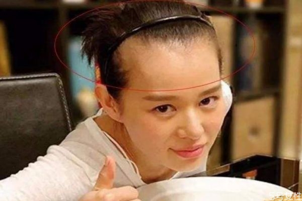 發(fā)際線高適合什么樣的發(fā)型 發(fā)際線后移怎么辦 發(fā)際線高適合什么樣的發(fā)型 發(fā)際線后移怎么辦