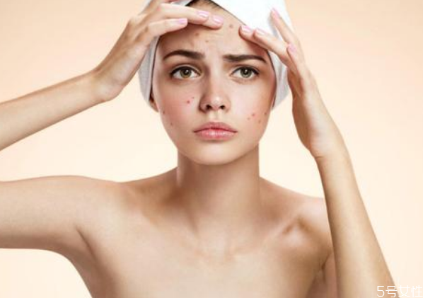 戴口罩下巴長(zhǎng)痘痘怎么辦 怎樣避免戴口罩悶痘 戴口罩下巴長(zhǎng)痘痘怎么辦 怎樣避免戴口罩悶痘