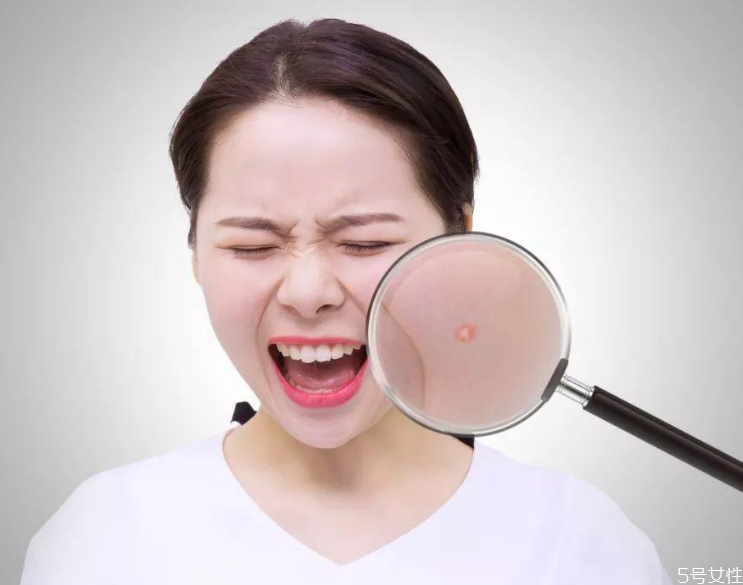 戴口罩長痘痘涂什么藥膏 口罩悶痘怎么快速消除 戴口罩長痘痘涂什么藥膏 口罩悶痘怎么快速消除