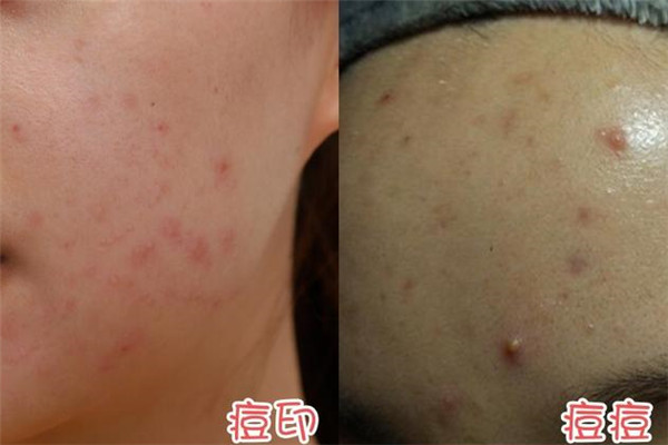 我的皮膚老是長(zhǎng)痘痘是什么原因呢 我的皮膚老是長(zhǎng)痘痘是什么原因呢