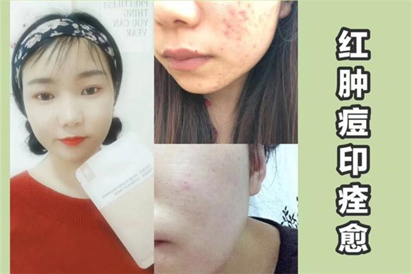 我的皮膚老是長(zhǎng)痘痘是什么原因呢 我的皮膚老是長(zhǎng)痘痘是什么原因呢