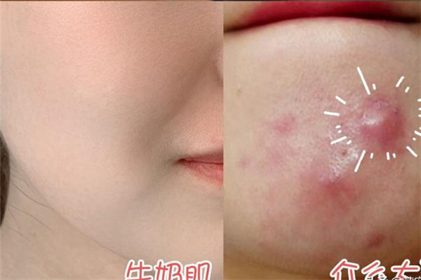 我的皮膚老是長(zhǎng)痘痘是什么原因呢 我的皮膚老是長(zhǎng)痘痘是什么原因呢