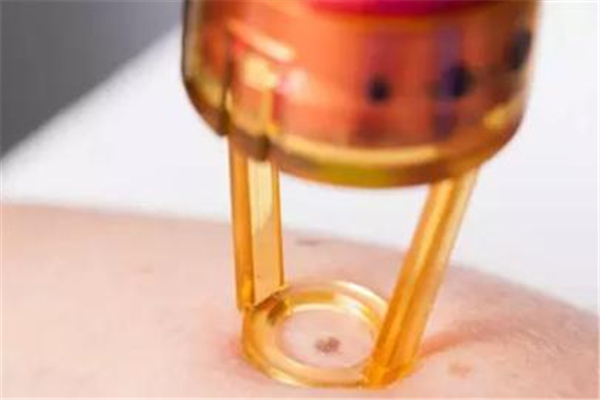 點(diǎn)痣有風(fēng)險(xiǎn)嗎 點(diǎn)痣需要注意哪些事項(xiàng) 點(diǎn)痣有風(fēng)險(xiǎn)嗎 點(diǎn)痣需要注意哪些事項(xiàng)