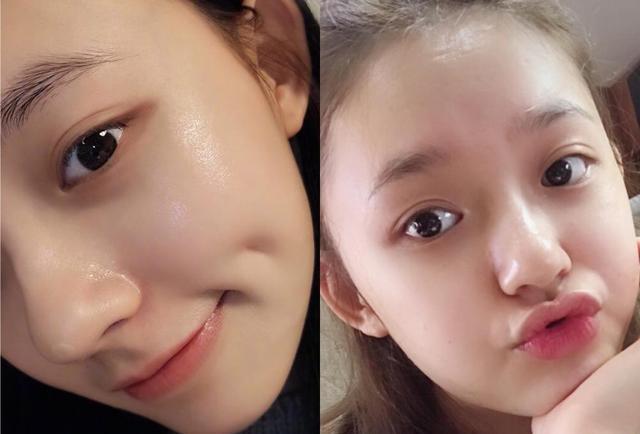 打水光針幾天能恢復好呢 打水光針的好處和壞處 打水光針幾天能恢復好呢 打水光針的好處和壞處