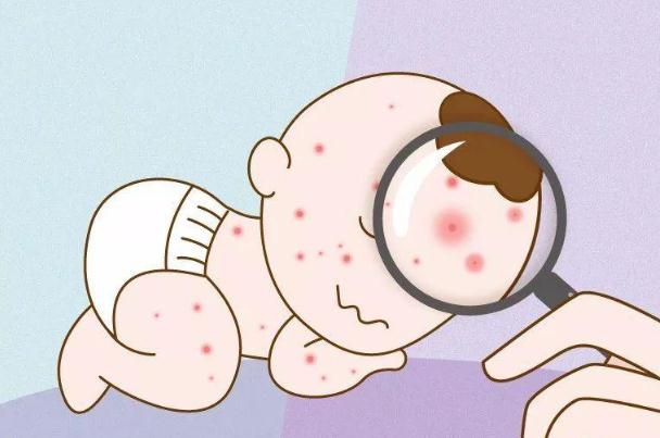 嬰兒濕疹反復(fù)發(fā)作原因 嬰兒濕疹怎么治才能好得快 嬰兒濕疹反復(fù)發(fā)作原因 嬰兒濕疹怎么治才能好得快