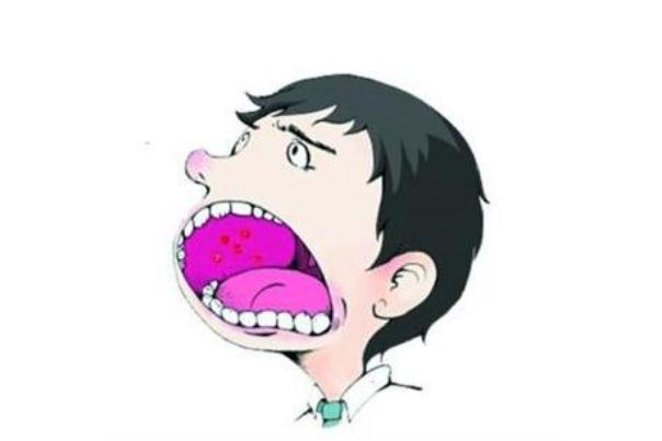 口腔潰瘍的早期癥狀 口腔潰瘍的表現(xiàn)癥狀 口腔潰瘍的早期癥狀 口腔潰瘍的表現(xiàn)癥狀