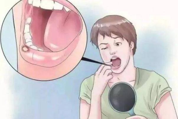 口腔潰瘍反復(fù)發(fā)作怎么根治 口腔潰瘍反復(fù)發(fā)作是怎么回事 口腔潰瘍反復(fù)發(fā)作怎么根治 口腔潰瘍反復(fù)發(fā)作是怎么回事