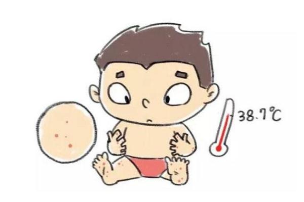 蕁麻疹是否有傳染 蕁麻疹是屬于過(guò)敏體質(zhì)嗎 蕁麻疹是否有傳染 蕁麻疹是屬于過(guò)敏體質(zhì)嗎