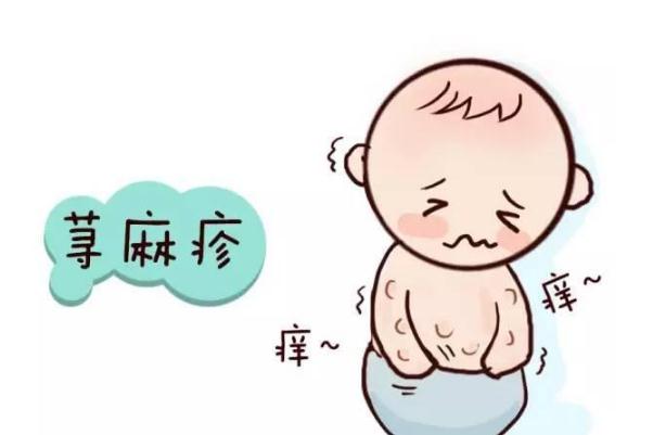 蕁麻疹是否有傳染 蕁麻疹是屬于過(guò)敏體質(zhì)嗎 蕁麻疹是否有傳染 蕁麻疹是屬于過(guò)敏體質(zhì)嗎