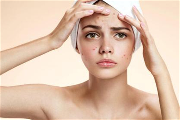 夏天臉上長(zhǎng)痘痘怎么回事 為什么夏天臉上愛(ài)長(zhǎng)痘 夏天臉上長(zhǎng)痘痘怎么回事 為什么夏天臉上愛(ài)長(zhǎng)痘