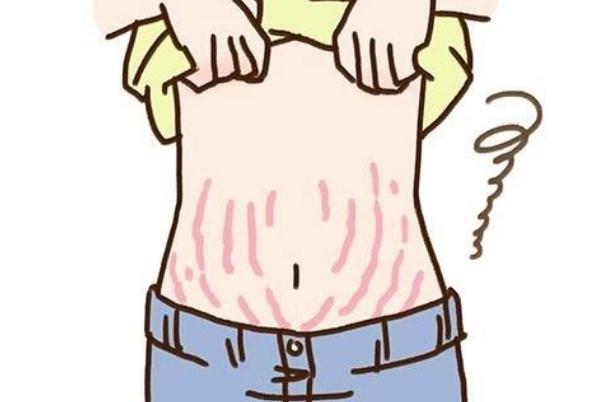 妊娠紋可以通過手術(shù)去除嗎 妊娠紋可以自然恢復(fù)嗎 妊娠紋可以通過手術(shù)去除嗎 妊娠紋可以自然恢復(fù)嗎