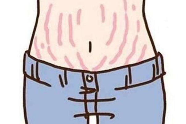 妊娠紋是什么原因引起的 妊娠紋多久會自然淡化 妊娠紋是什么原因引起的 妊娠紋多久會自然淡化