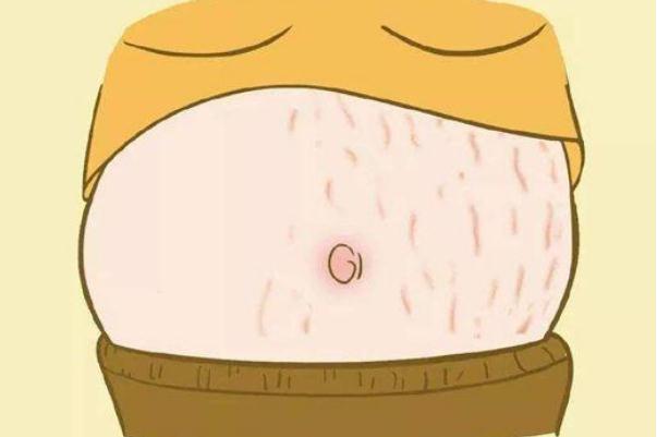 妊娠紋癢可以撓嗎 吃什么預(yù)防妊娠紋 妊娠紋癢可以撓嗎 吃什么預(yù)防妊娠紋