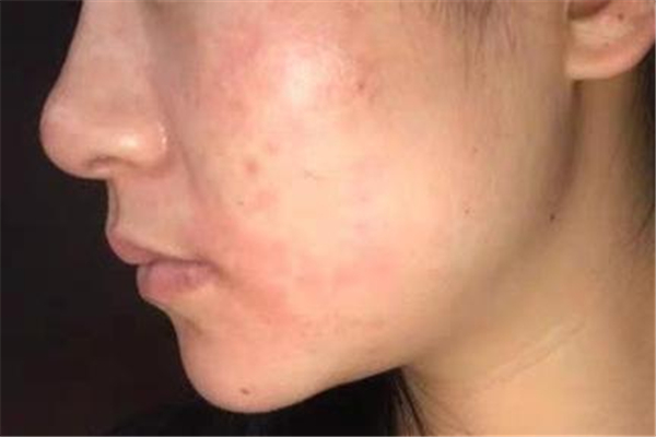 敏感肌臉部發(fā)紅怎么修復(fù) 敏感肌怎么修復(fù)成正常肌膚 敏感肌臉部發(fā)紅怎么修復(fù) 敏感肌怎么修復(fù)成正常肌膚