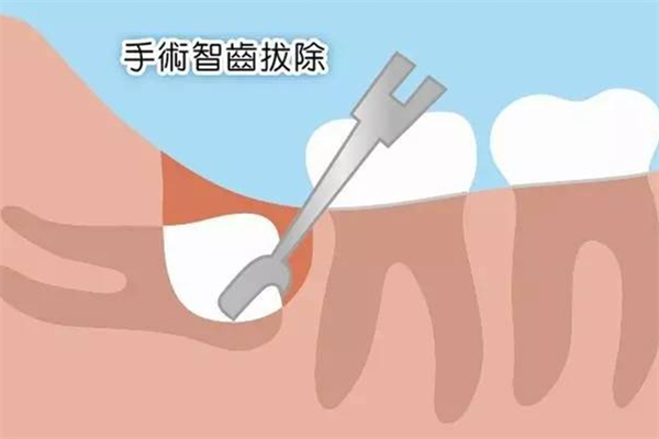 智齒有必要拔嗎 智齒不拔有什么危害 智齒有必要拔嗎 智齒不拔有什么危害