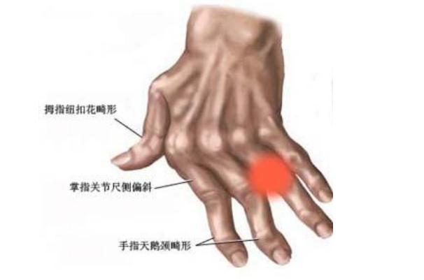 風濕病可以根治嗎 風濕病可以吹空調嗎 風濕病可以根治嗎 風濕病可以吹空調嗎