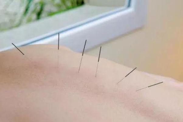 針灸有危險(xiǎn)嗎 針灸有什么好處和壞處