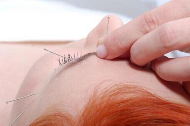 針灸可以洗澡不 針灸能治哪些病 針灸可以洗澡不 針灸能治哪些病