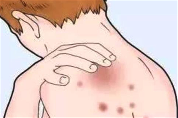 蕁麻疹中醫(yī)能治好嗎 蕁麻疹中醫(yī)調(diào)理需要多長(zhǎng)時(shí)間好 蕁麻疹中醫(yī)能治好嗎 蕁麻疹中醫(yī)調(diào)理需要多長(zhǎng)時(shí)間好