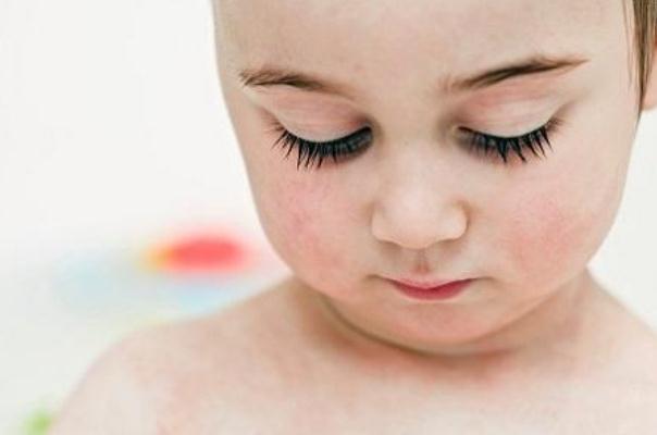 寶寶濕疹反復(fù)是過敏嗎 寶寶濕疹反復(fù)不好怎么辦 寶寶濕疹反復(fù)是過敏嗎 寶寶濕疹反復(fù)不好怎么辦