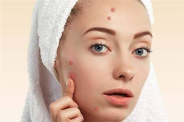 上火會長痘痘嗎 上火長痘痘怎么調(diào)理 上火會長痘痘嗎 上火長痘痘怎么調(diào)理