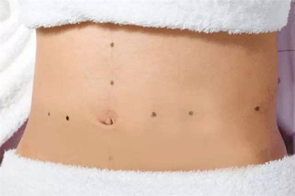 埋線減肥效果好不好 埋線減肥要做幾次才有效果 埋線減肥效果好不好 埋線減肥要做幾次才有效果