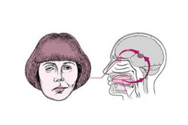 面癱針灸多久會好 面癱針灸治療最佳時間 面癱針灸多久會好 面癱針灸治療最佳時間